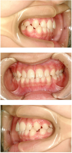 正中離開 （すきっ歯） | 愛知県豊田市の矯正歯科専門 - 三宅矯正歯科クリニック